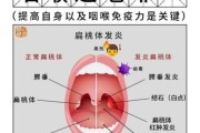 高原扁桃体发炎怎么办_高原旅行如何预防