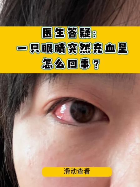 高原眼睛充血怎么办_高原反应眼睛红怎么缓解