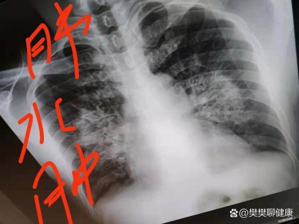 高原肺水肿为什么致命_高原肺水肿多久会死