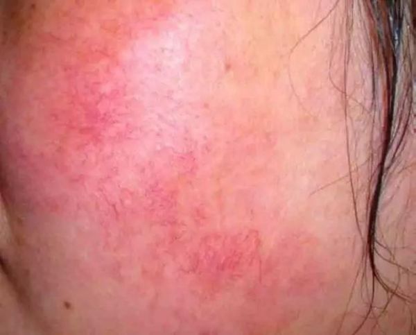 高原红长沙怎么治_高原红长沙医院哪家好