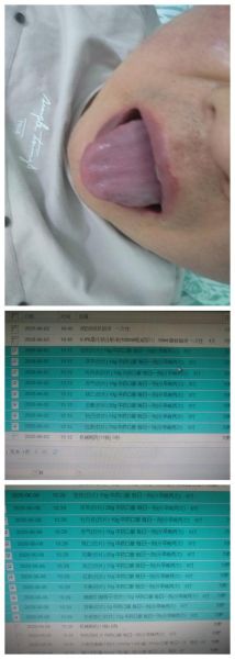 南昌高原红怎么治_南昌高原红会自愈吗