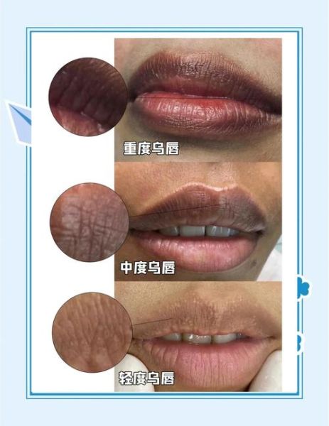 到了高原嘴唇发紫怎么办_高原反应嘴唇发紫正常吗