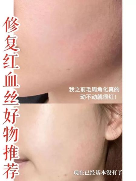 长沙高原红怎么治_长沙高原红修复医院哪家好