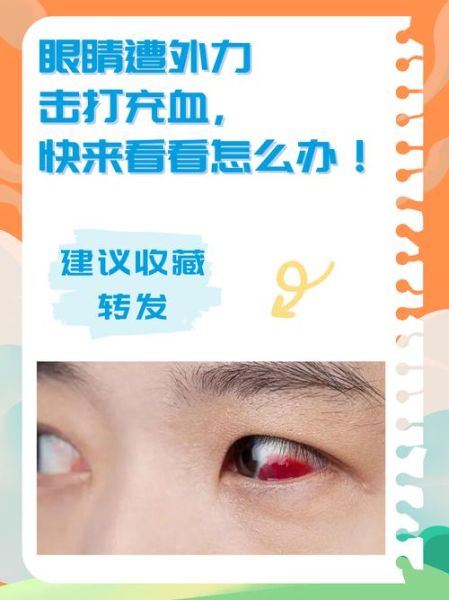 高原反应眼睛充血怎么办_高原眼睛充血多久能好