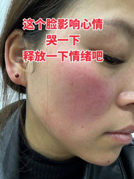 高原反应会不会过敏_高原过敏症状有哪些