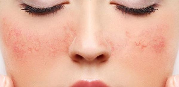 南昌高原红怎么治_南昌高原红医院哪家好