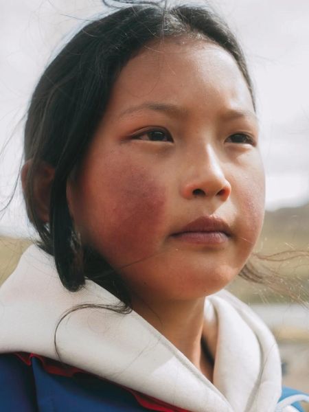 新疆会有高原红吗_高原红成因与预防