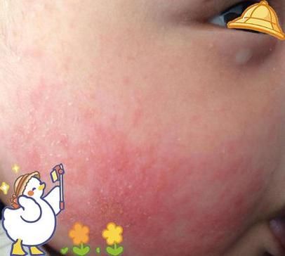 小孩子有高原反应吗_儿童高原反应症状与预防