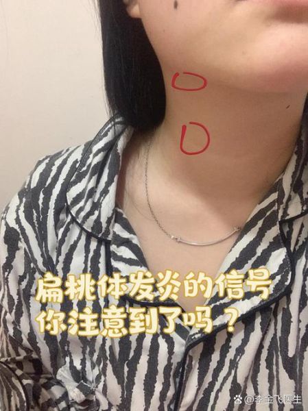 扁桃体发炎能上高原吗_高原反应会加重吗